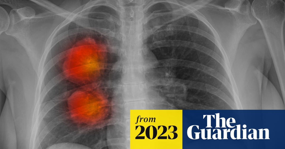 New artificial intelligence tool can accurately identify cancer