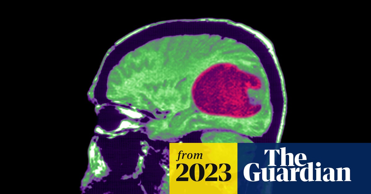 New AI tool can help treat brain tumors more quickly and accurately, study finds