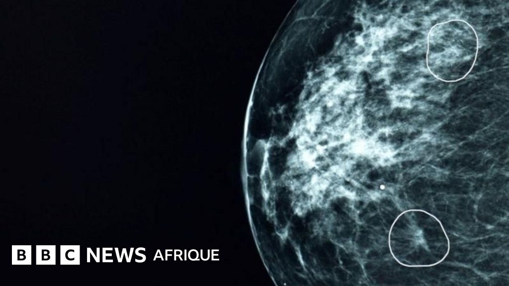 Intelligence artificielle : l'outil qui détecte les tumeurs cancéreuses que les médecins ne peuvent pas voir - BBC News Afrique