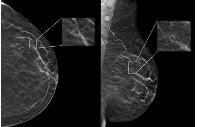 New Study Finds That Age and Race Affect Artificial Intelligence (AI) Performance in Digital Mammograms